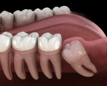 Patient receiving wisdom teeth consultation
